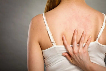 sulfite allergy